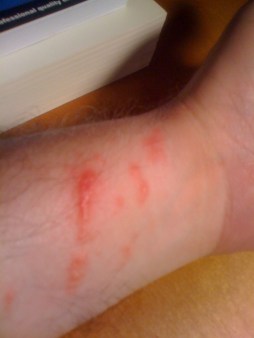 Rash on arm